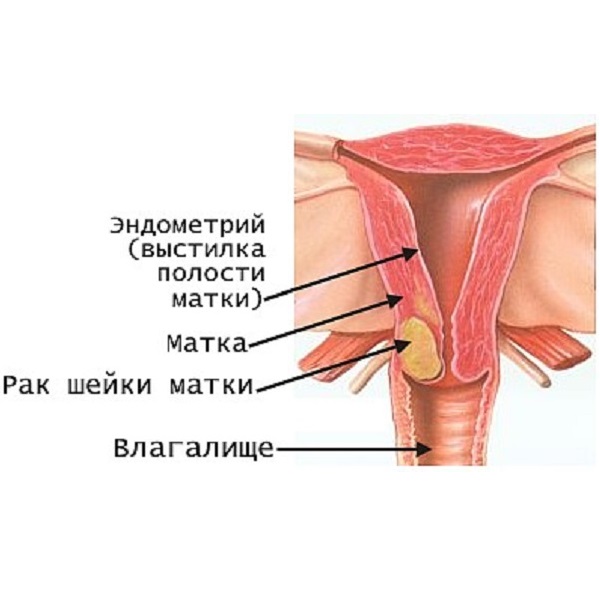 Рак шейки матки. Лечение.