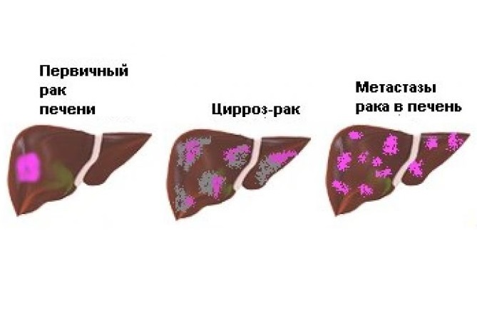 Рак печени. Лечение.